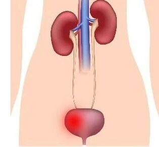 Reasons for the development of cystitis in women