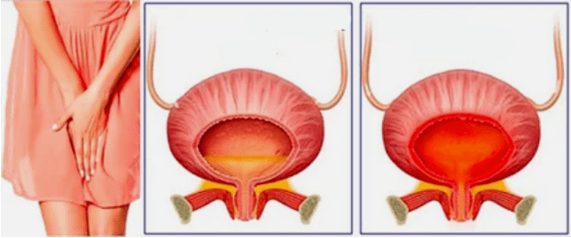 Chronic cystitis